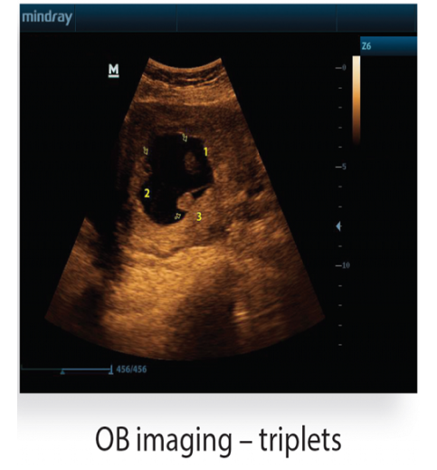 Mindray Z6 Portable Colour Doppler Ultrasound