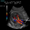 Siemens Acuson P300 Ultrasound