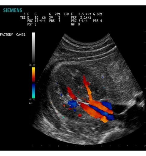 Siemens Acuson P300 Ultrasound Siemens Acuson P300 Ultrasound